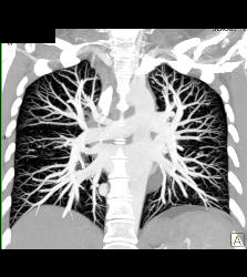 Pulmonary Arteriovenous Malformation (PAVM) in Multiple Projections - CTisus CT Scan