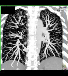 Pulmonary Arteriovenous Malformation (PAVM) in Multiple Projections - CTisus CT Scan