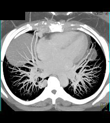 Pulmonary Arteriovenous Malformation (PAVM) in Multiple Projections - CTisus CT Scan