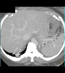 Pulmonary Arteriovenous Malformation (PAVM) in Multiple Projections - CTisus CT Scan