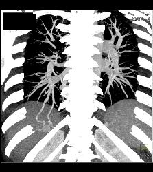 Pulmonary Arteriovenous Malformation (PAVM) in Multiple Projections - CTisus CT Scan