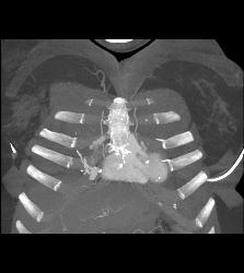 Pulmonary Arteriovenous Malformation (PAVM) in Multiple Projections - CTisus CT Scan