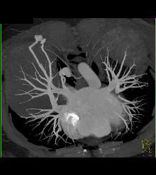 Pulmonary Arteriovenous Malformation (PAVM) in Multiple Projections - CTisus CT Scan