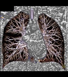 Pulmonary Arteriovenous Malformation (PAVM) in Multiple Projections - CTisus CT Scan