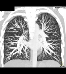 Pulmonary Arteriovenous Malformation (PAVM) in Multiple Projections - CTisus CT Scan