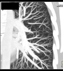 Pulmonary Arteriovenous Malformation (PAVM) in Multiple Projections - CTisus CT Scan