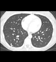 Pulmonary Arteriovenous Malformation (PAVM) in Multiple Projections - CTisus CT Scan