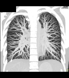 Pulmonary Arteriovenous Malformation (PAVM) in Multiple Projections - CTisus CT Scan