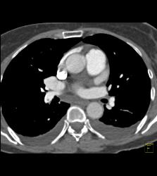 Pulmonary Embolism - CTisus CT Scan