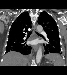 Pulmonary Embolism - CTisus CT Scan