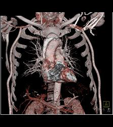 Axillary Bifemoral Grafts for Aortic Occlusion - CTisus CT Scan