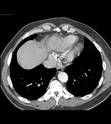 Incidental Pulmonary Embolism (PE) in Patient With Pancreatic Cancer - CTisus CT Scan