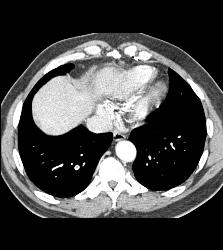 Incidental Pulmonary Embolism (PE) in Patient With Pancreatic Cancer - CTisus CT Scan