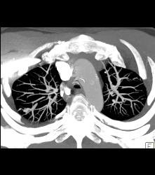 Pulmonary Arteriovenous Malformation (PAVM) in 3D - CTisus CT Scan