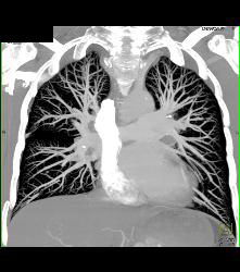 Pulmonary Arteriovenous Malformation (PAVM) in 3D - CTisus CT Scan