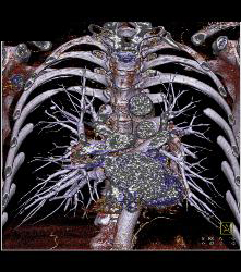 Pulmonary Arteriovenous Malformation (PAVM) in 3D - CTisus CT Scan