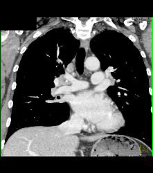 Pulmonary Arteriovenous Malformation (PAVM) in 3D - CTisus CT Scan