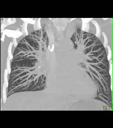 Pulmonary Arteriovenous Malformation (PAVM) in 3D - CTisus CT Scan