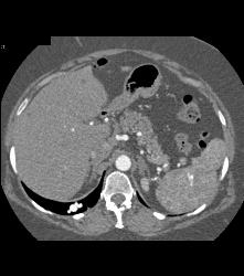 Pulmonary Arteriovenous Malformation (PAVM) in 3D - CTisus CT Scan