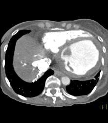 Poor Cardiac Function and Reflux of Contrast Into IVC - CTisus CT Scan