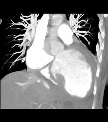 Poor Cardiac Function and Reflux of Contrast Into IVC - CTisus CT Scan