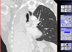 Occlusion of Right Mainstem Bronchus By Carcinoid Tumor - CTisus CT Scan