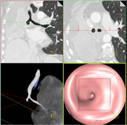 Occlusion of Right Mainstem Bronchus By Carcinoid Tumor - CTisus CT Scan