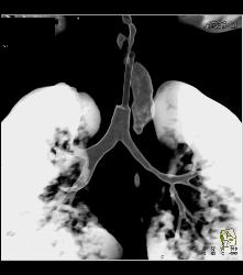 Tracheostomy With Narrow Left Mainstem Bronchus and Virtual Endoscopy - CTisus CT Scan