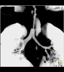 Tracheostomy With Narrow Left Mainstem Bronchus and Virtual Endoscopy - CTisus CT Scan