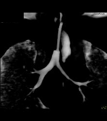 Tracheostomy With Narrow Left Mainstem Bronchus and Virtual Endoscopy - CTisus CT Scan