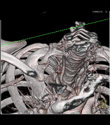 Cervical Rib With Occluded Right Subclavian Artery- Patient Had Subclavian Steal Symptoms - CTisus CT Scan