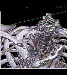 Cervical Rib With Occluded Right Subclavian Artery- Patient Had Subclavian Steal Symptoms - CTisus CT Scan