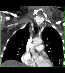 Cervical Rib With Occluded Right Subclavian Artery- Patient Had Subclavian Steal Symptoms - CTisus CT Scan