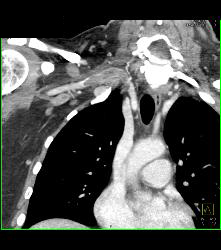 Cervical Rib With Occluded Right Subclavian Artery- Patient Had Subclavian Steal Symptoms - CTisus CT Scan