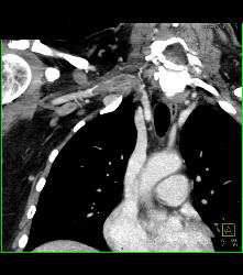 Cervical Rib With Occluded Right Subclavian Artery- Patient Had Subclavian Steal Symptoms - CTisus CT Scan