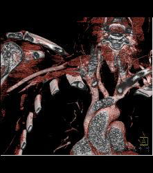 Cervical Rib With Occluded Right Subclavian Artery- Patient Had Subclavian Steal Symptoms - CTisus CT Scan