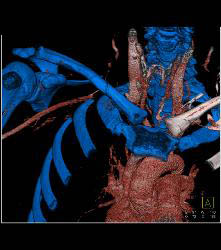 Cervical Ribs With Occluded Right Subclavian Artery- Patient Had Subclavian Steal Symptoms - CTisus CT Scan