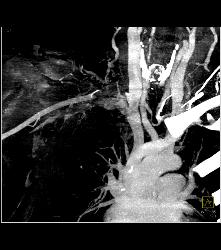 Right Subclavian and Axillary Artery Clot in Patient With Subclavian Steal Symptoms- Multiple Sequences - CTisus CT Scan