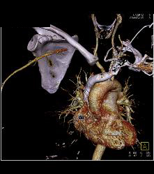 Right Subclavian and Axillary Artery Clot in Patient With Subclavian Steal Symptoms- Multiple Sequences - CTisus CT Scan