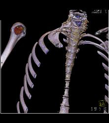 Right Subclavian and Axillary Artery Clot in Patient With Subclavian Steal Symptoms- Multiple Sequences - CTisus CT Scan