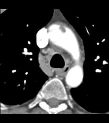 Clot in Aorta - CTisus CT Scan