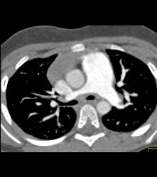 Pulmonary Artery Aneurysm - CTisus CT Scan
