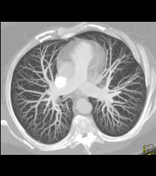 Normal Pulmonary Artery - CTisus CT Scan