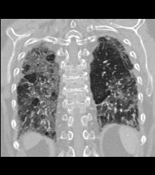Idiopathic Pulmonary Fibrosis (IPF) With Pulmonary Hypertension - CTisus CT Scan