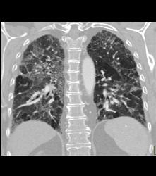 Idiopathic Pulmonary Fibrosis (IPF) With Pulmonary Hypertension - CTisus CT Scan