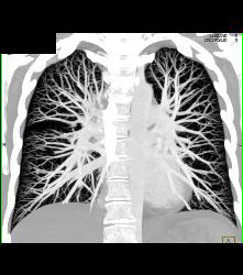 Normal Pulmonary Vasculature - CTisus CT Scan