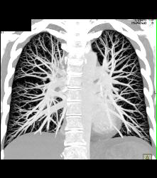Normal Pulmonary Vasculature - CTisus CT Scan