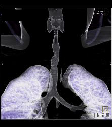 Tracheal Stenosis Due to Prior Intubation - CTisus CT Scan