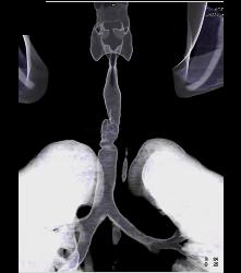 Tracheal Stenosis Due to Prior Intubation - CTisus CT Scan