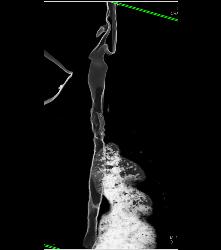 Tracheal Stenosis Due to Prior Intubation - CTisus CT Scan